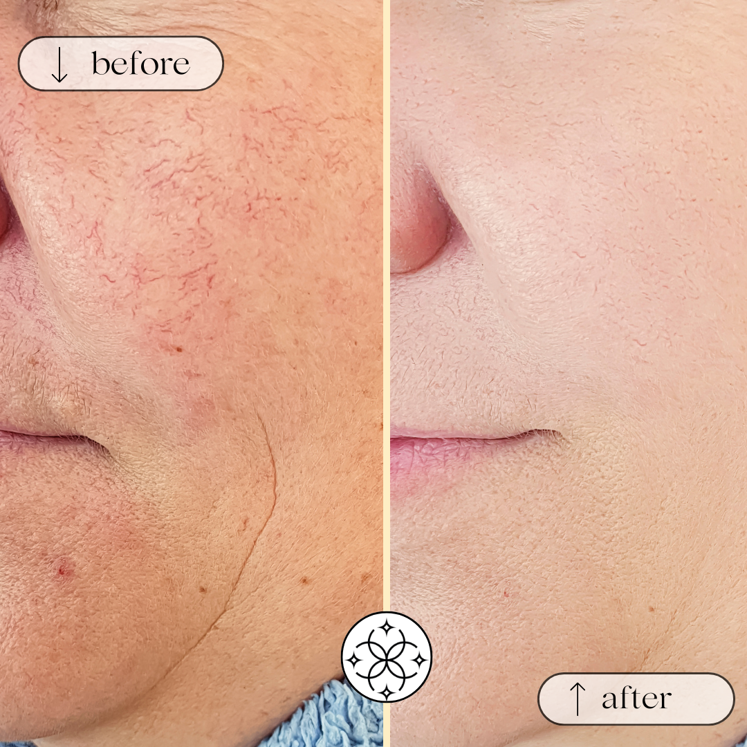 Medical Beauty: Couperose & Rosacea im Charisma Beautycenter Neckarsulm